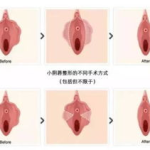 做私密整形费用,价格背后的秘密与选择指南